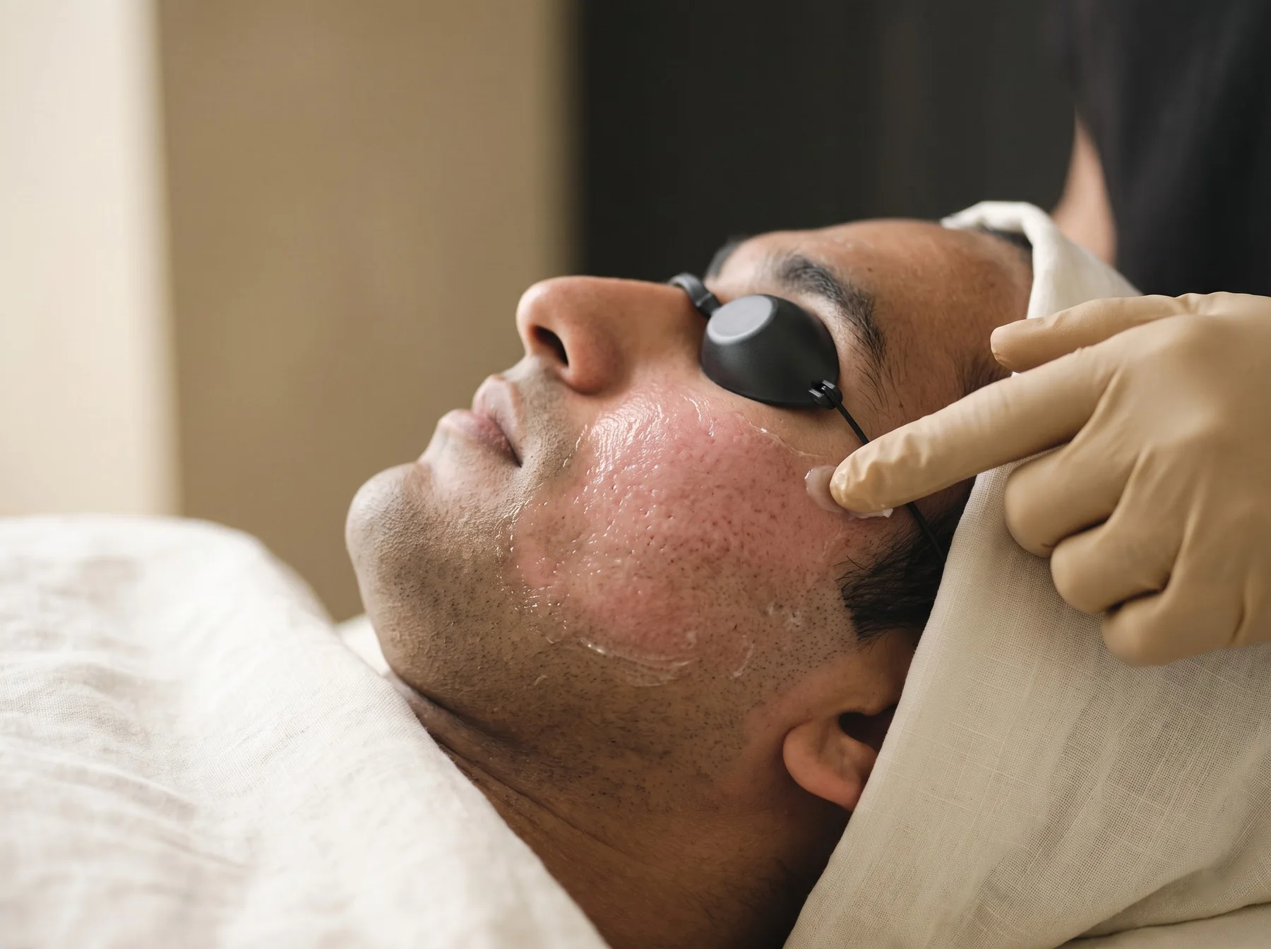Ablative CO₂ Laser at Own Skin Dermatology & Advanced Aesthetics, Camp, Pune