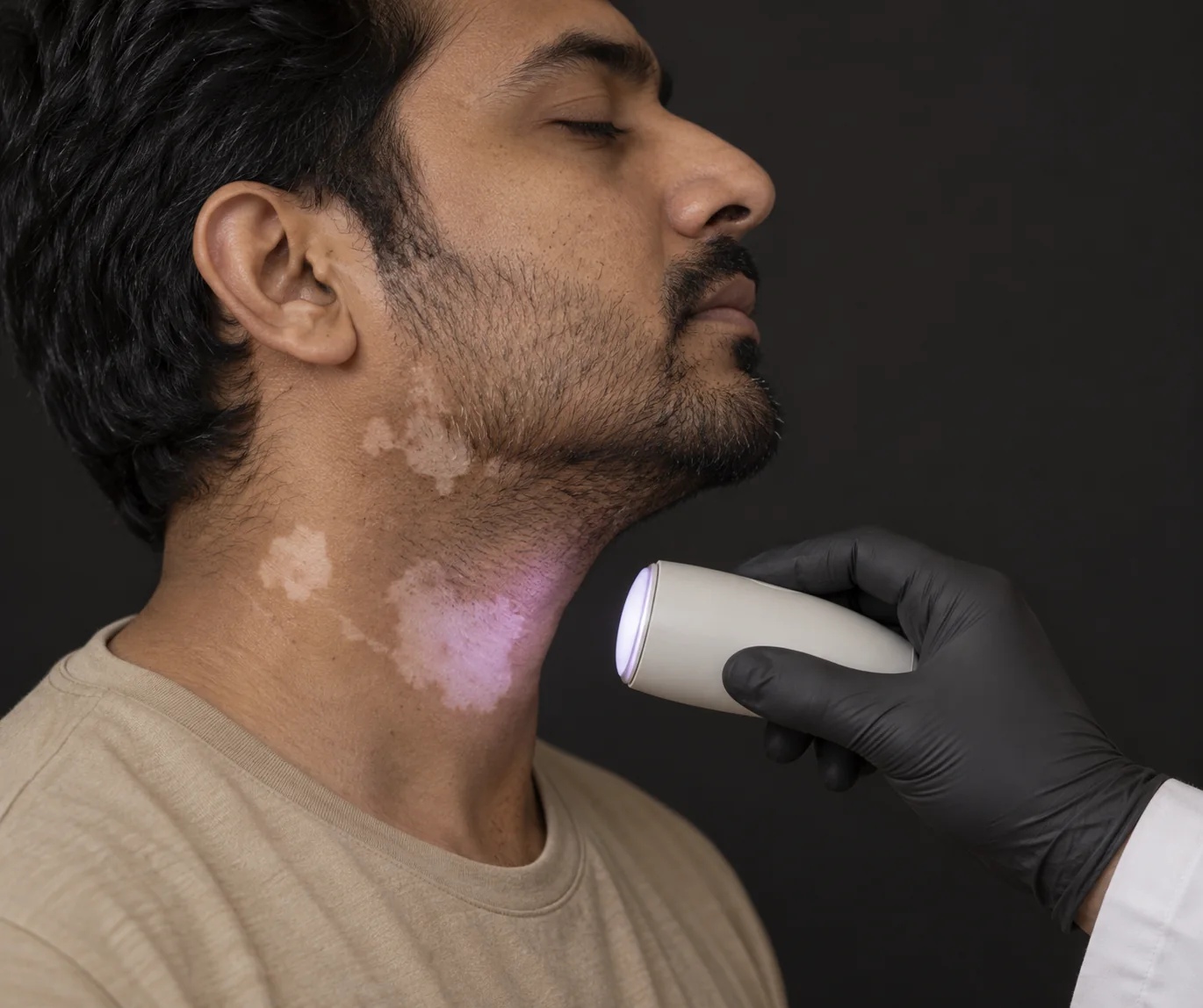 Advanced Vitiligo Care