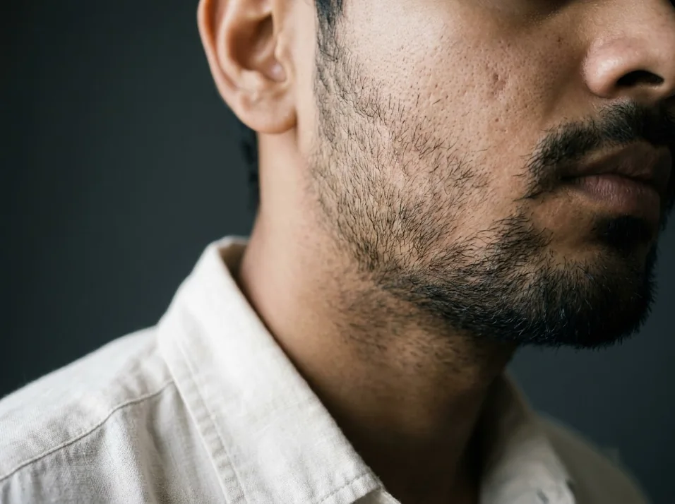 Beard & Patchy Growth treated at Own Skin Dermatology & Advanced Aesthetics