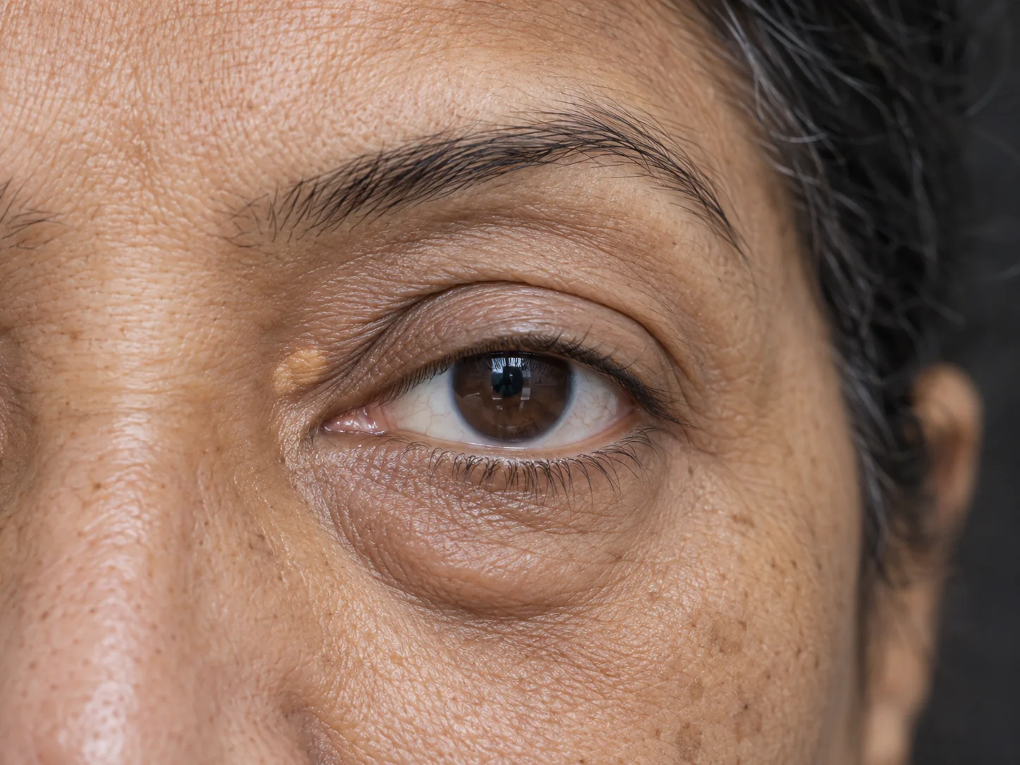 Blepharoplasty (for Xanthelasma, Eyelid Lift & Undereye Bag Removal Surgery)