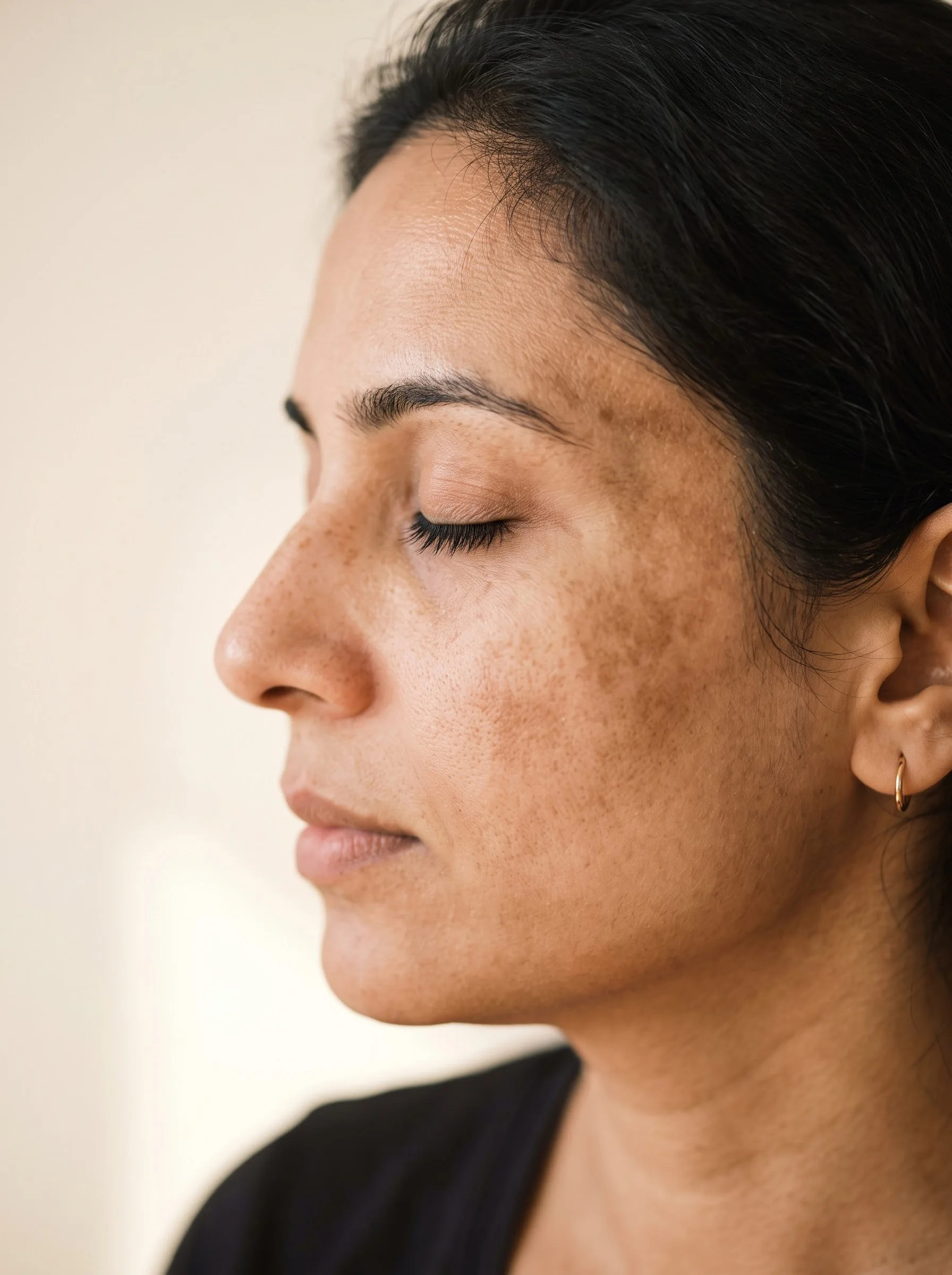 Pigmentation & Melasma, dermatology care at Own Skin, Camp, Pune