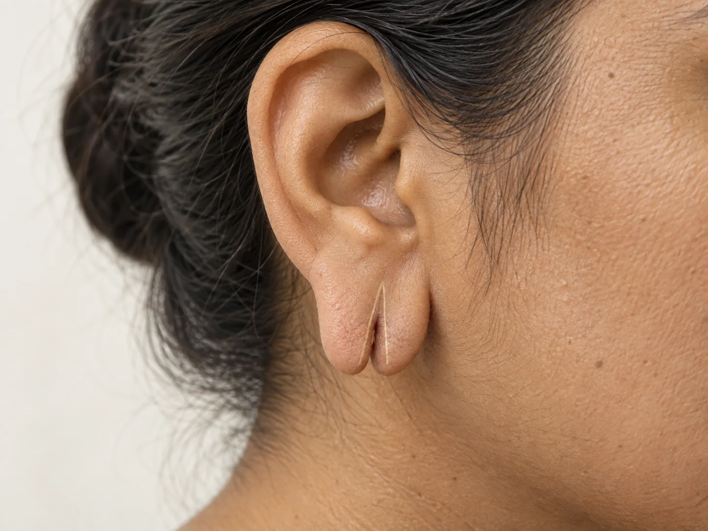 Earlobe & Nose Piercing Restoration