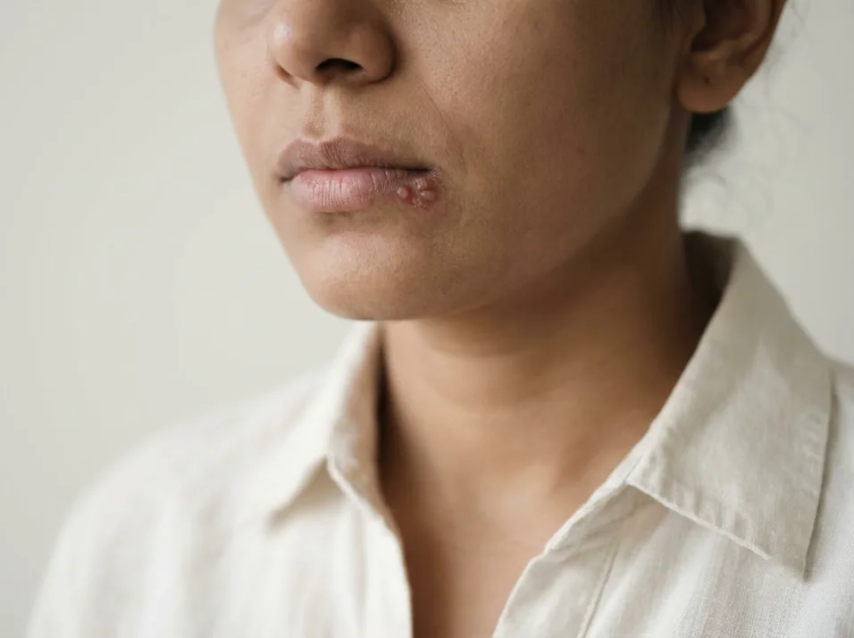 Herpes & Viral Infections treated at Own Skin Dermatology & Advanced Aesthetics