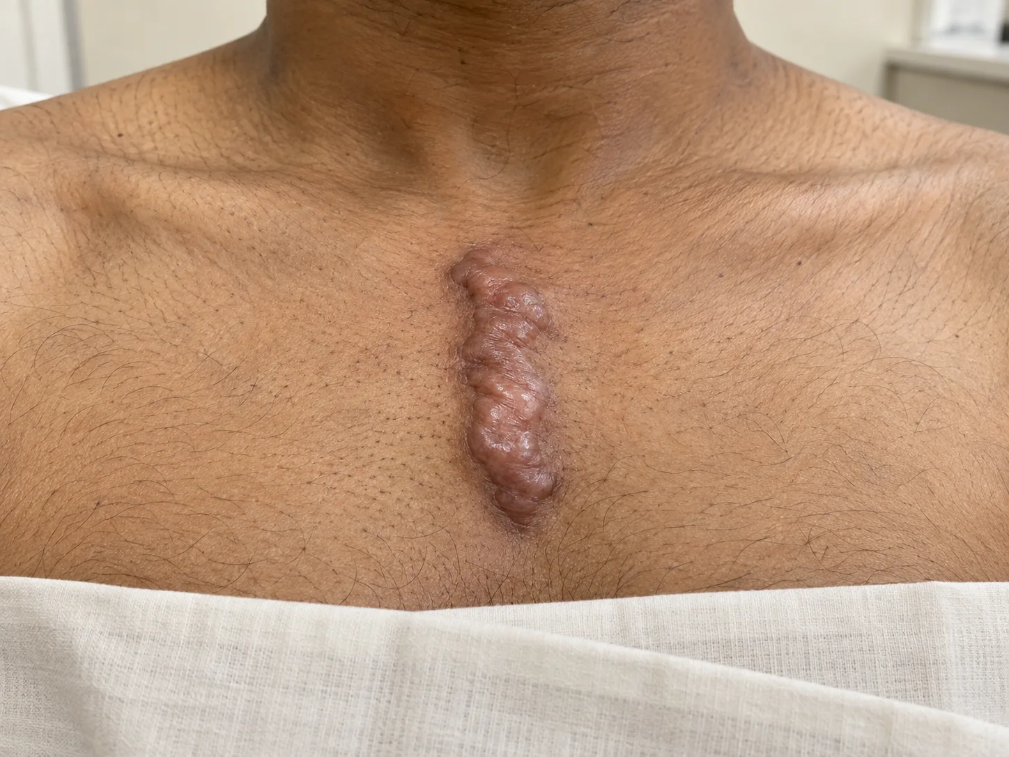 Keloid Surgery