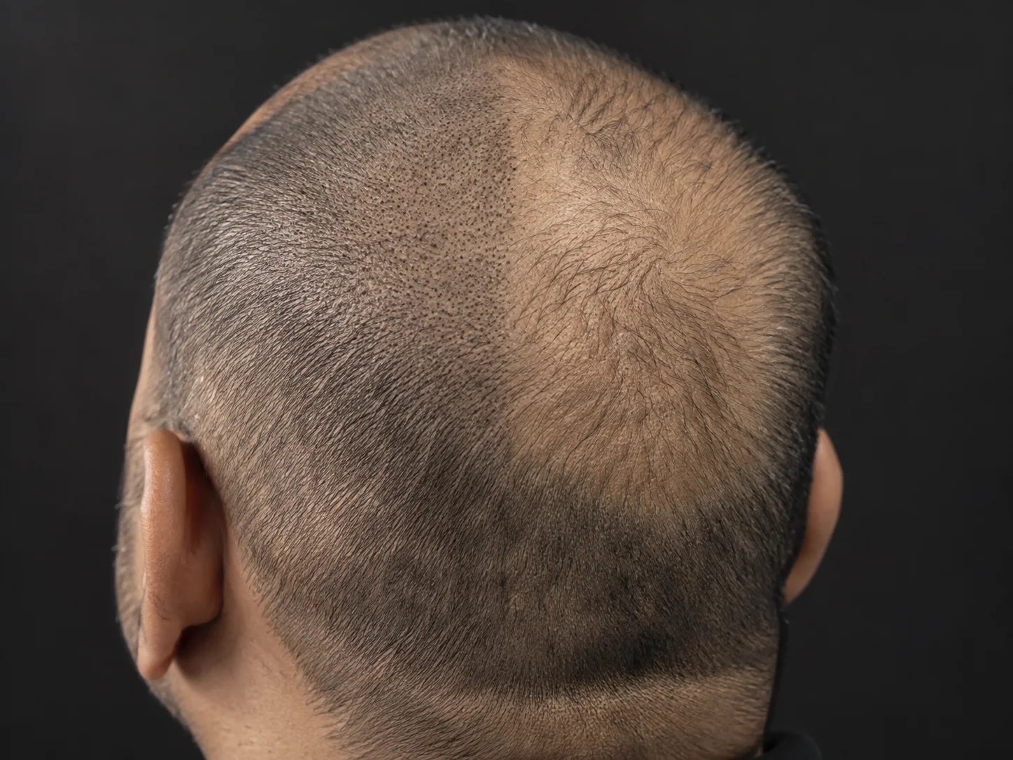 Scalp Micropigmentation (SMP)