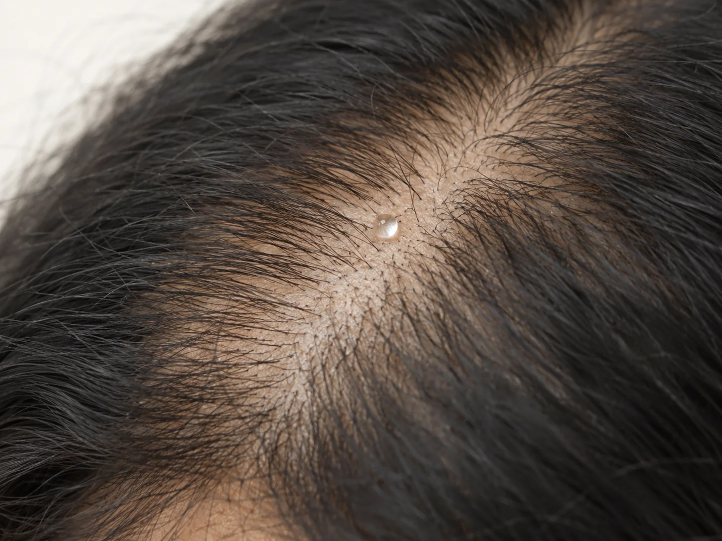 Stem Cell Scalp Therapy