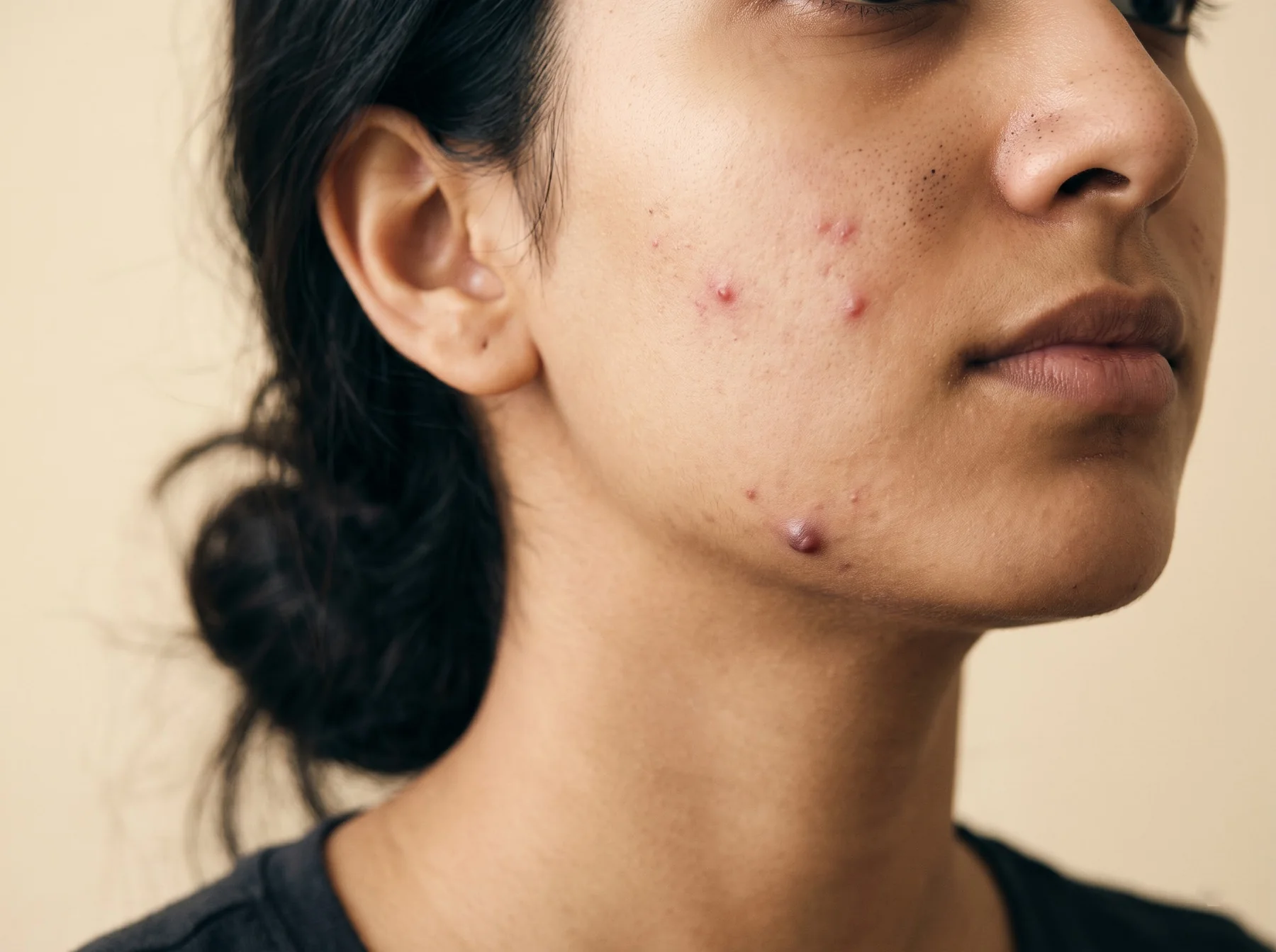 Types of acne & breakouts on Indian skin, dermatologist assessment at Own Skin, Camp, Pune