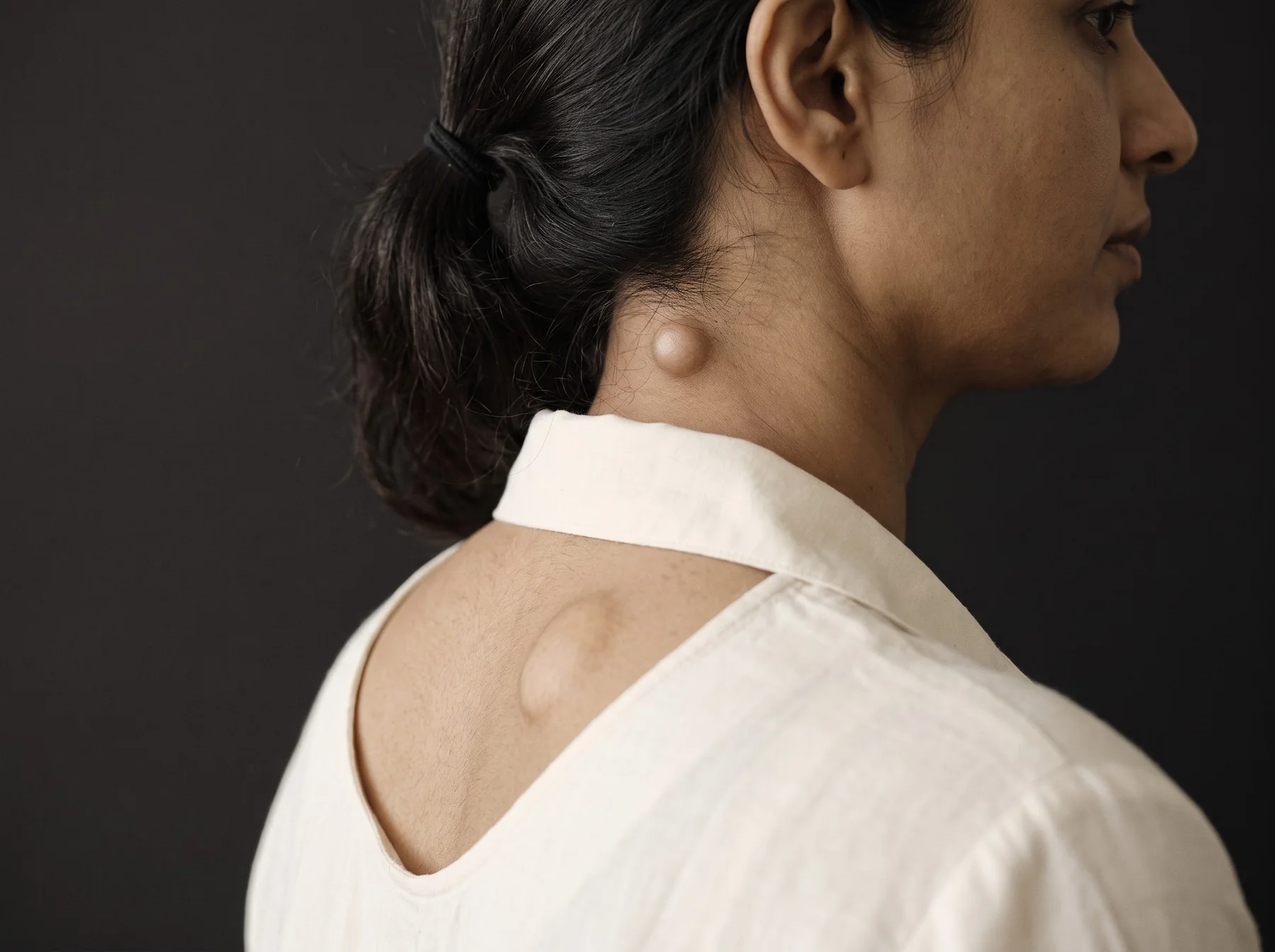 Types of cysts & skin lumps on Indian skin, dermatologist assessment at Own Skin, Camp, Pune