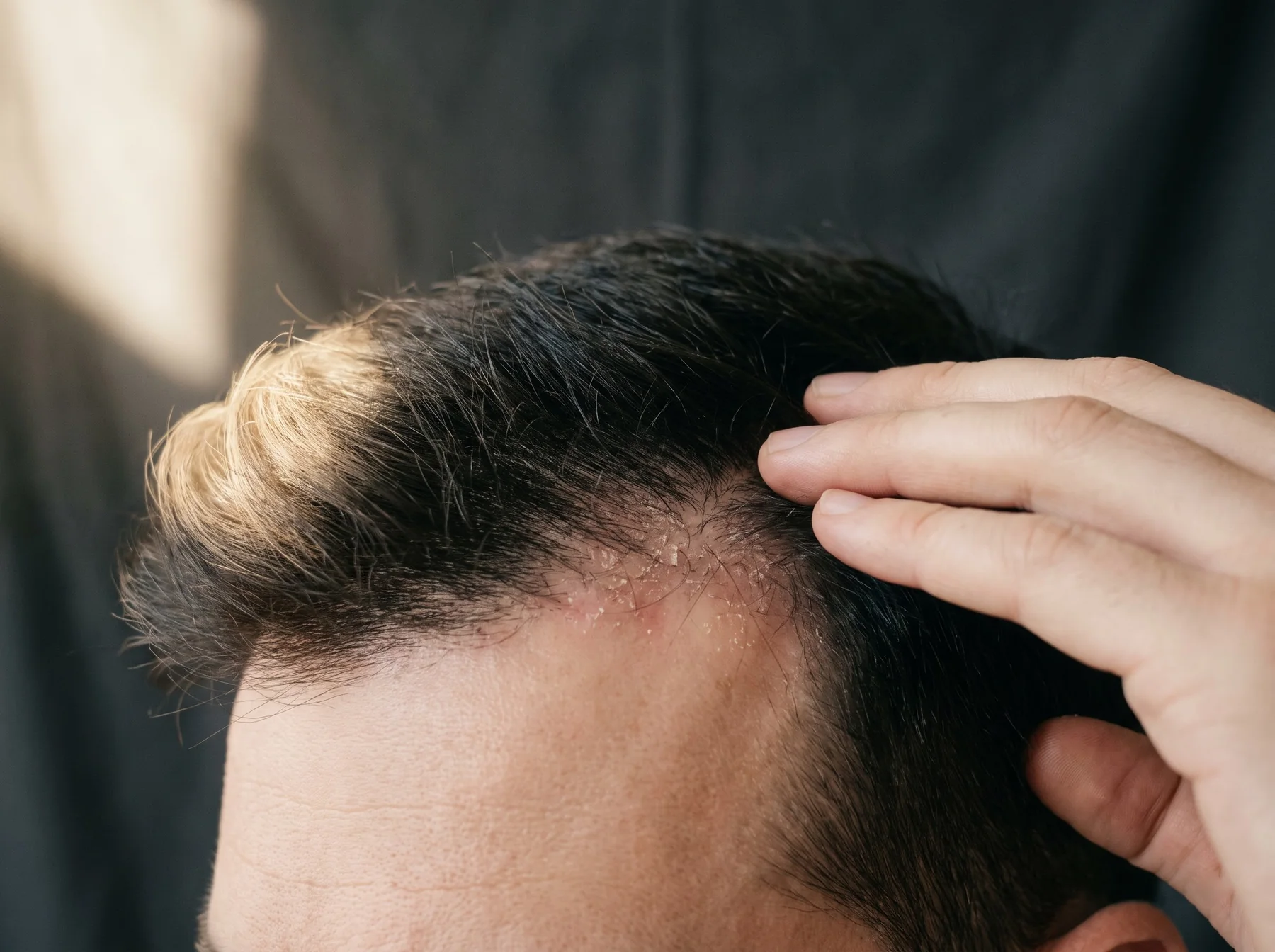 Types of dandruff & scalp health on Indian skin, dermatologist assessment at Own Skin, Camp, Pune