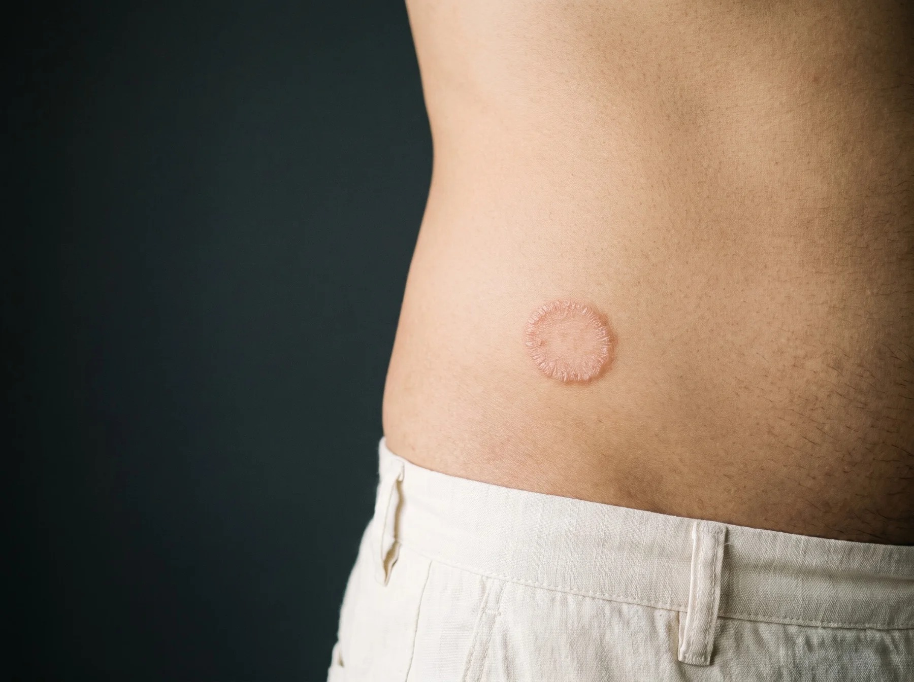 Types of fungal infections on Indian skin, dermatologist assessment at Own Skin, Camp, Pune