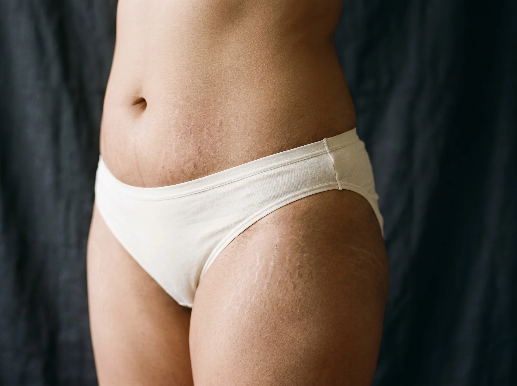 Types of scars & stretch marks on Indian skin, dermatologist assessment at Own Skin, Camp, Pune