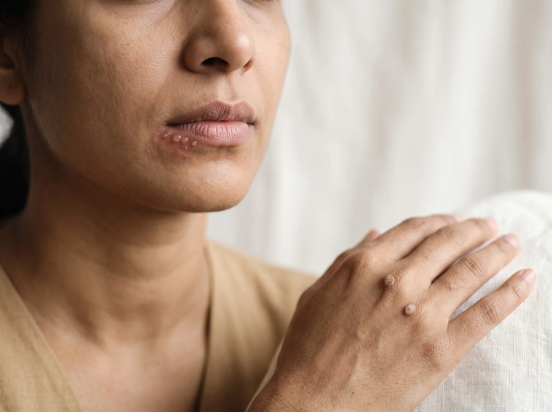 Types of herpes & viral infections on Indian skin, dermatologist assessment at Own Skin, Camp, Pune