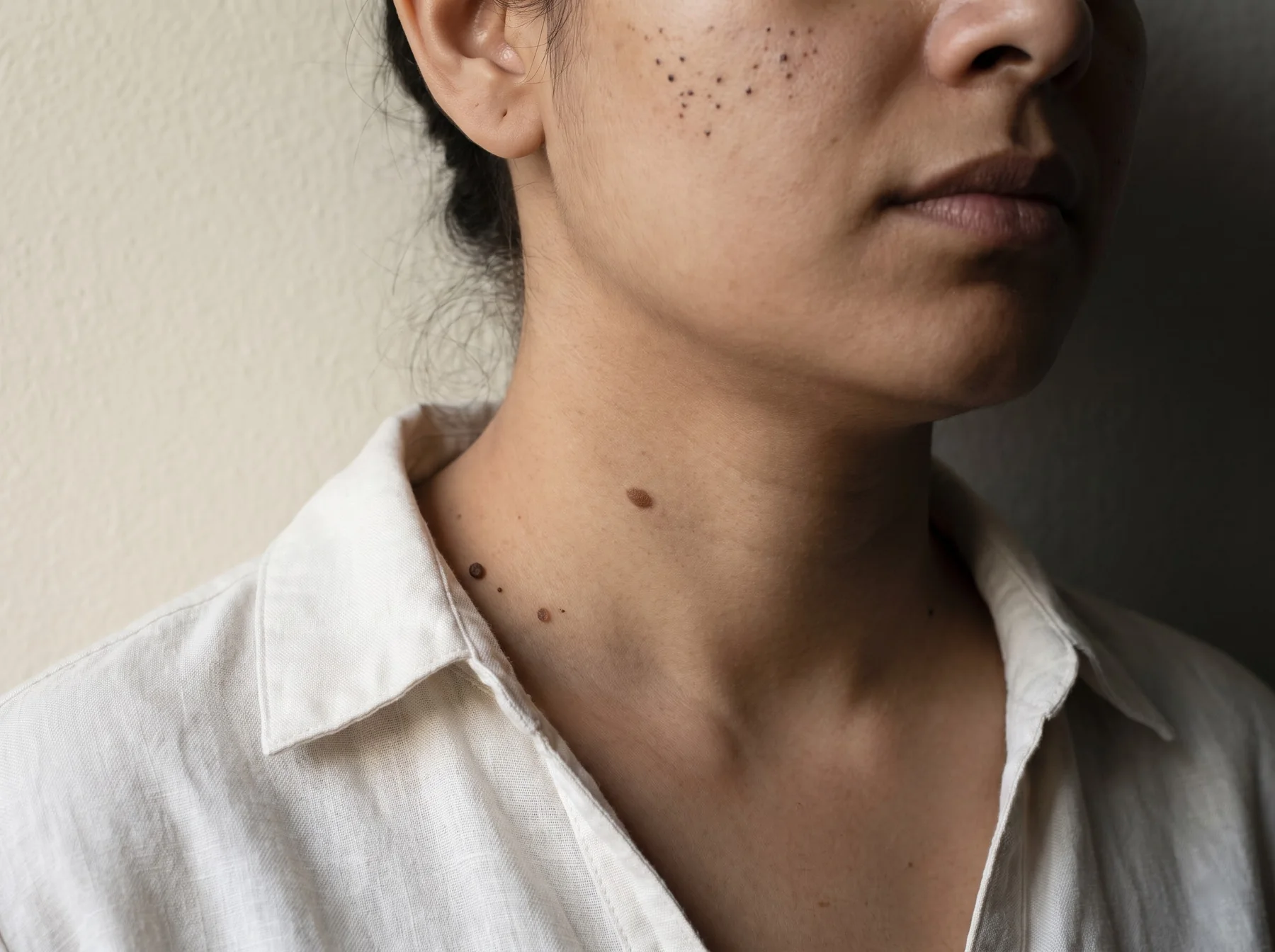 Types of warts, moles & skin tags on Indian skin, dermatologist assessment at Own Skin, Camp, Pune