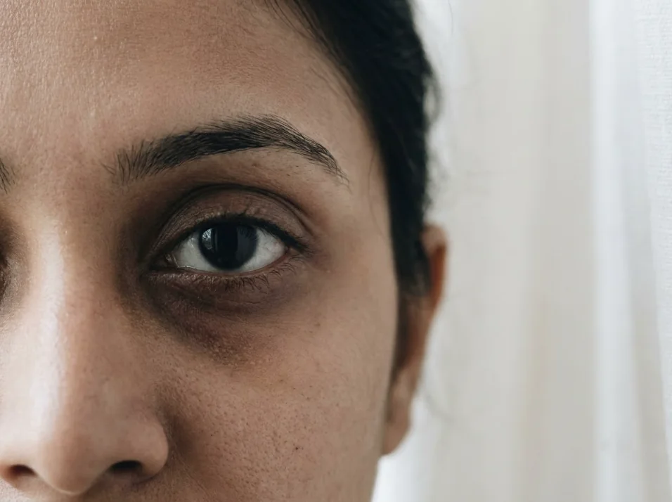 Under-Eye Circles treated at Own Skin Dermatology & Advanced Aesthetics